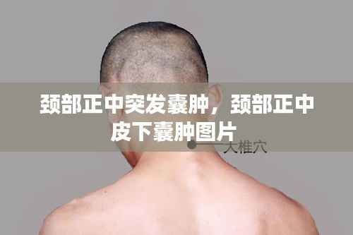 颈部正中突发囊肿,颈部正中皮下囊肿图片